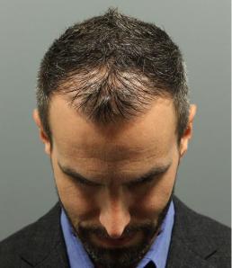 hair-restoration-austin-tx