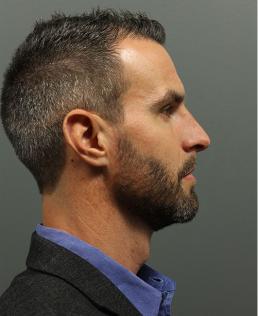 hair-restoration-austin-tx