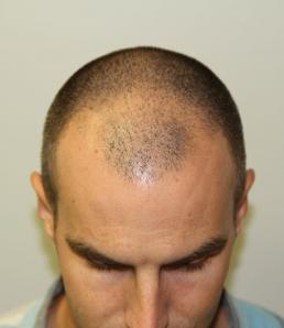 hair-restoration-austin-tx