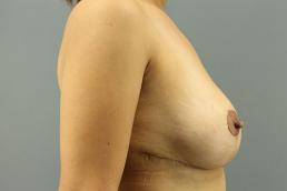 breast-reduction-austin-tx