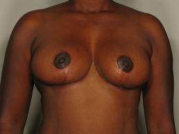 breast-reduction-austin-tx breast-reduction-austin-tx