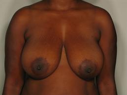 breast-reduction-austin-tx breast-reduction-austin-tx