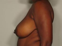 breast-reduction-austin-tx breast-reduction-austin-tx