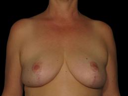 breast-reduction-austin-tx breast-reduction-austin-tx