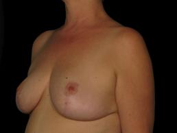 breast-reduction-austin-tx breast-reduction-austin-tx