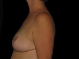 breast-reduction-austin-tx breast-reduction-austin-tx