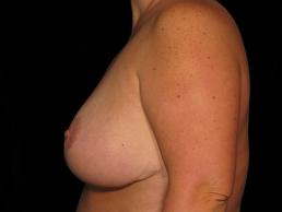 breast-reduction-austin-tx breast-reduction-austin-tx