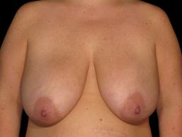breast-reduction-austin-tx breast-reduction-austin-tx