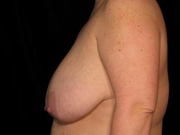breast-reduction-austin-tx breast-reduction-austin-tx