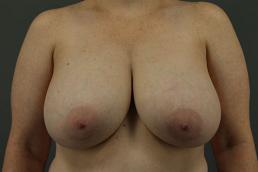 breast-reduction-austin-tx