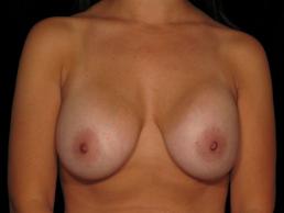 breast-revision-austin-tx breast-revision-austin-tx