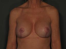 breast-revision-austin-tx