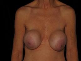 breast-revision-austin-tx