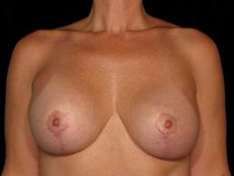 breast-revision-austin-tx