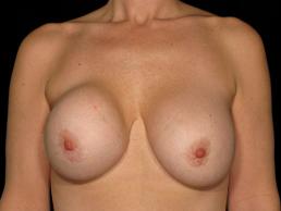 breast-revision-austin-tx