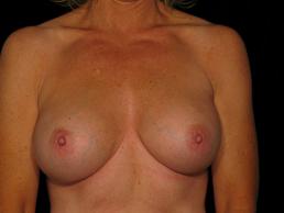 breast-revision-austin-tx