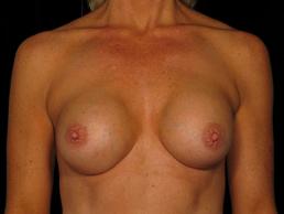 breast-revision-austin-tx