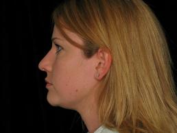 rhinoplasty-austin-tx