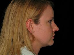 rhinoplasty-austin-tx