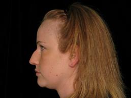 rhinoplasty-austin-tx