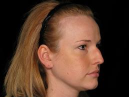 rhinoplasty-austin-tx