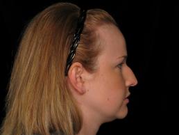 rhinoplasty-austin-tx