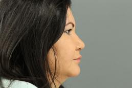 rhinoplasty-austin-tx