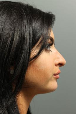 rhinoplasty-austin-tx