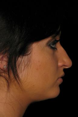 rhinoplasty-austin-tx