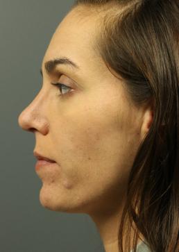 rhinoplasty-austin-tx