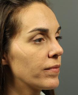 rhinoplasty-austin-tx