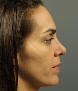 rhinoplasty-austin-tx