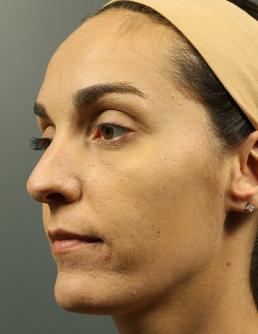 rhinoplasty-austin-tx