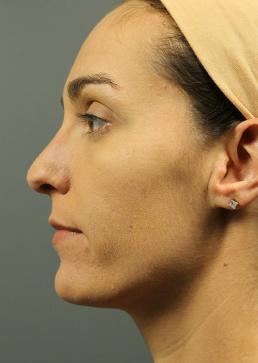 rhinoplasty-austin-tx