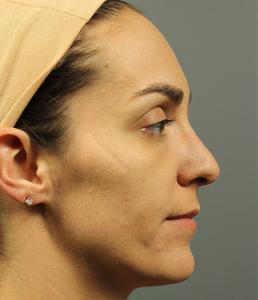 rhinoplasty-austin-tx