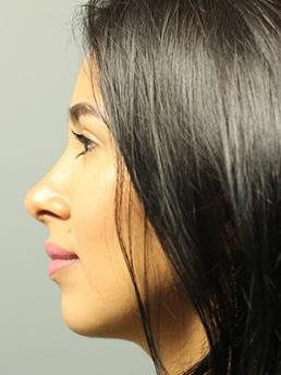 rhinoplasty-austin-tx