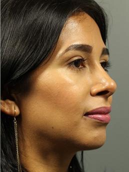 rhinoplasty-austin-tx