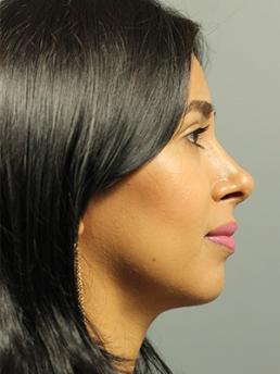 rhinoplasty-austin-tx