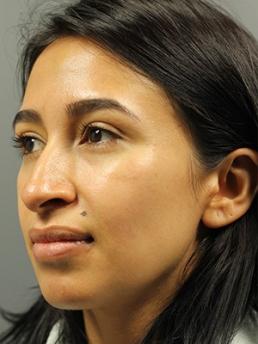 rhinoplasty-austin-tx