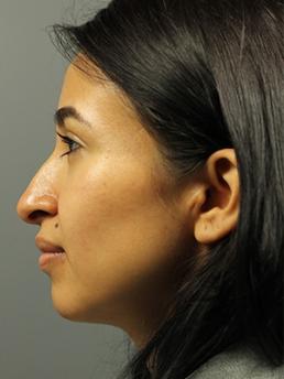 rhinoplasty-austin-tx