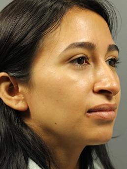 rhinoplasty-austin-tx