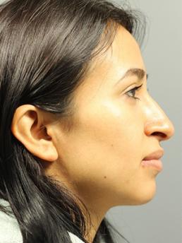 rhinoplasty-austin-tx