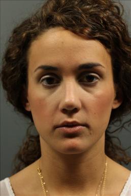 rhinoplasty-austin-tx