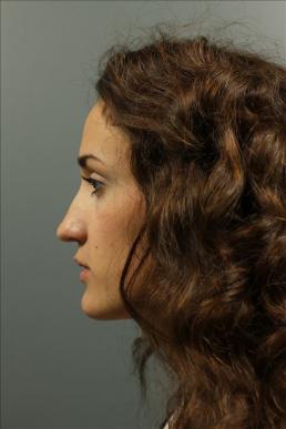 rhinoplasty-austin-tx
