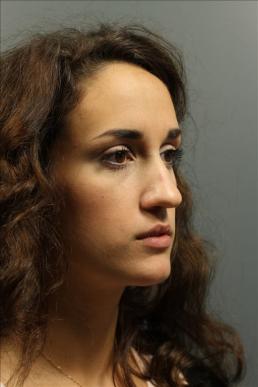 rhinoplasty-austin-tx