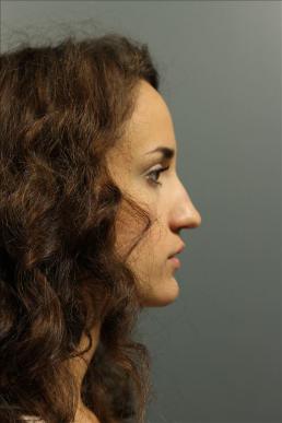 rhinoplasty-austin-tx