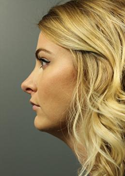 rhinoplasty-austin-tx