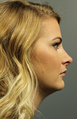 rhinoplasty-austin-tx