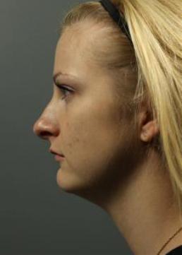 rhinoplasty-austin-tx