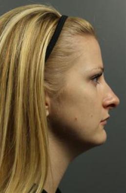 rhinoplasty-austin-tx